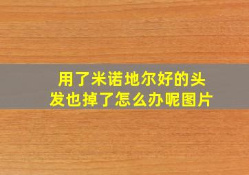 用了米诺地尔好的头发也掉了怎么办呢图片