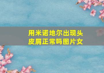 用米诺地尔出现头皮屑正常吗图片女