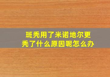 斑秃用了米诺地尔更秃了什么原因呢怎么办