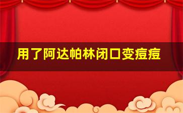 用了阿达帕林闭口变痘痘