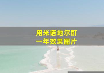 用米诺地尔酊一年效果图片