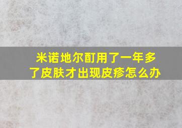 米诺地尔酊用了一年多了皮肤才出现皮疹怎么办