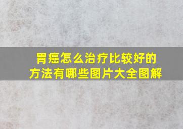 胃癌怎么治疗比较好的方法有哪些图片大全图解