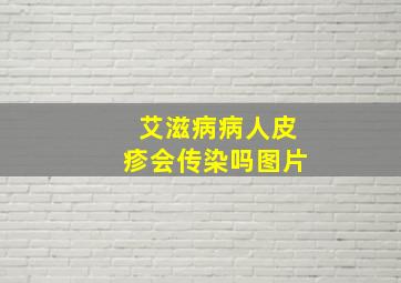 艾滋病病人皮疹会传染吗图片