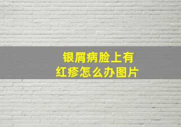 银屑病脸上有红疹怎么办图片